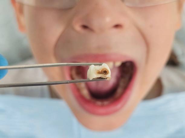Best Knocked-Out Tooth (Avulsed Tooth) Treatment in Glen Allen, VA